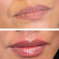 Aumento de labios - Dra. Paola León