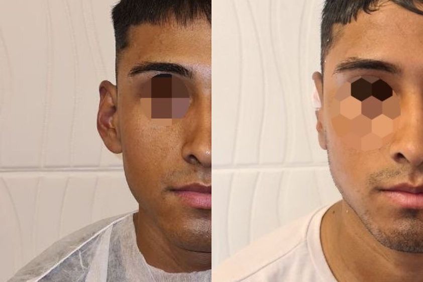 Otoplastia antes y después - 850792