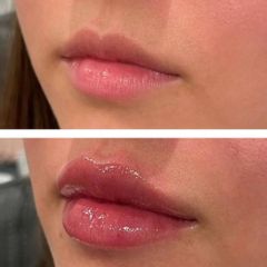 Aumento de labios - Dra. Paola León