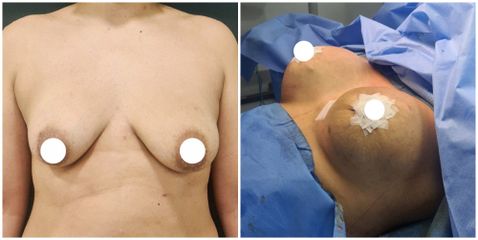 Mamoplastia de aumento - Dra. Paola León