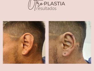 Otoplastia antes y después - 861335
