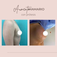 Mamoplastia de aumento - Dra. Paola León