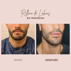 Aumento de labios - Dra. Paola León