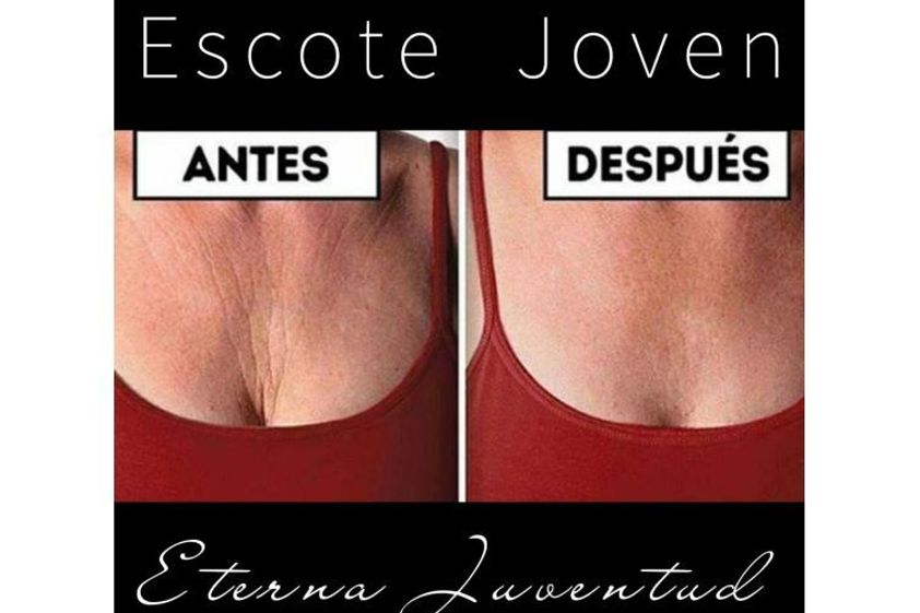 Carboxiterapia antes y después - 699505