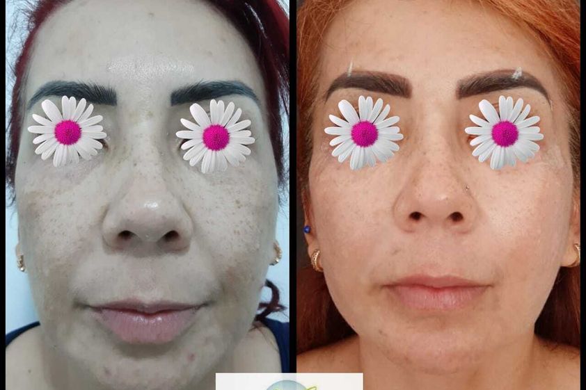 Peeling antes y después - 742172