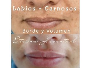Aumento de labios - Clínica Eterna Juventud