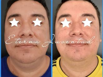 Rejuvenecimiento facial - 788346