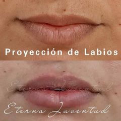 Aumento de labios - Clínica Eterna Juventud