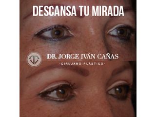 Blefaroplastia - Dr. Jorge Iván Cañas Palacio