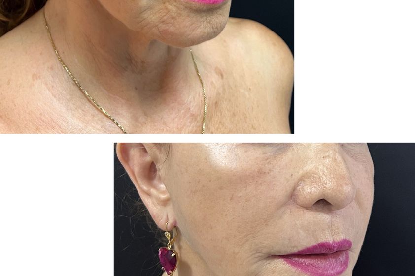 Lifting facial antes y después - 857139