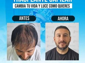 Implantes de cabello antes y después - 871191