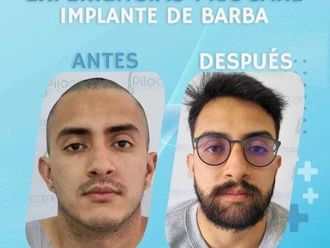 Implantes de cabello antes y después - 871192