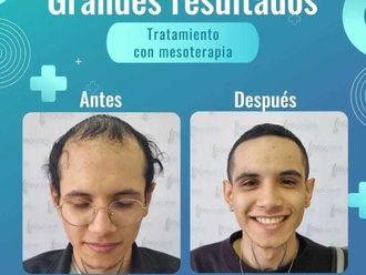 Mesoterapia antes y después - 871193