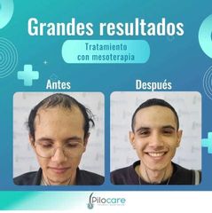 Trasplante Capilar con Mesoterapia - Pilocare