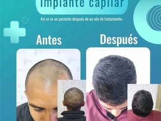 Implantes de cabello antes y después - 871194