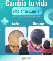 Implante Capilar - Pilocare