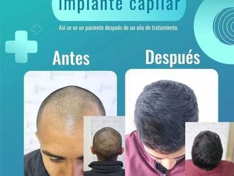 Tratamientos para el cabello antes y después - 871194