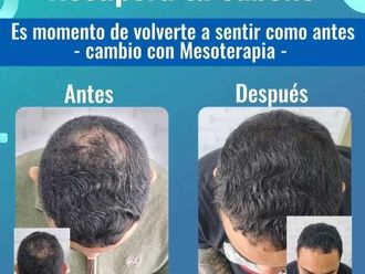Mesoterapia antes y después - 871195
