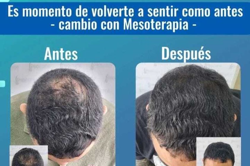 Mesoterapia antes y después - 871195