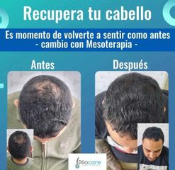 Resultados Naturales Mesoterapia Capilar - Pilocare