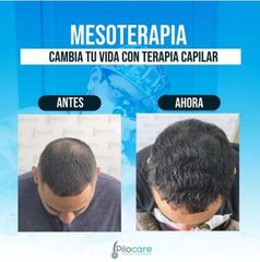 Tratamientos para el cabello - Pilocare