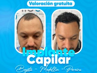 Alopecia antes y después - 879880