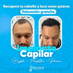 Transplante Capilar - Pilocare