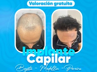 Implantes de cabello antes y después - 879881