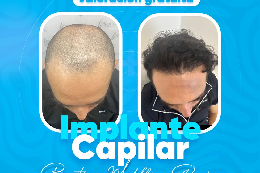 Implantes de cabello antes y después - 879881