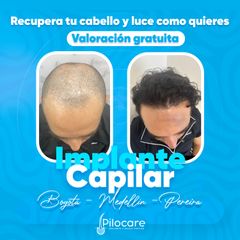 Implante capilar - Pilocare