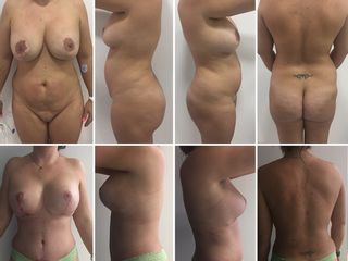 Moldeamiento de senos y abdomen