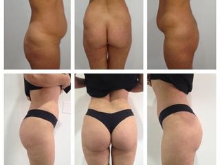 Lipoescultura con gluteoplastia