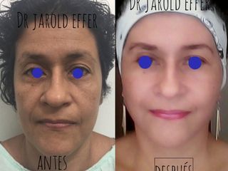 Rejuvenecimiento facial 