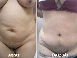 Antes y despues de dermolipectomia