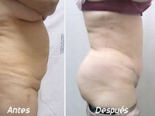 Antes y despues de dermolipectomia