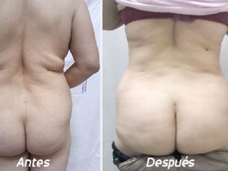 Antes y despues de dermolipectomia
