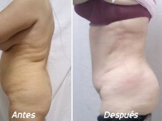 Antes y despues de dermolipectomia