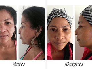Antes y despues de lifting facial