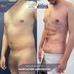 Abdominoplastia - Dr. Jarold Effer Taylor