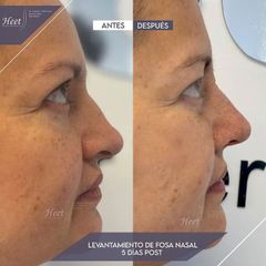 Rinoplastia - Dr. Jarold Effer Taylor