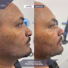 Rinoplastia - Dr. Jarold Effer Taylor