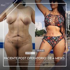 Lipoescultura - Dr. Jarold Effer Taylor