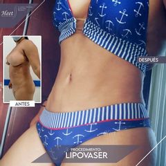 Liposucción - Dr. Jarold Effer Taylor
