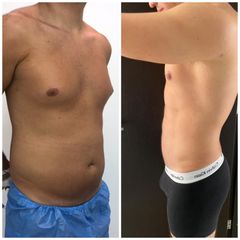 Abdominoplastia - Dr. Zamir Páez