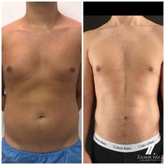 Abdominoplastia - Dr. Zamir Páez