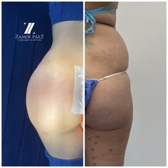 Gluteoplastia - Dr. Zamir Páez