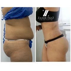 Abdominoplastia - Dr. Zamir Páez