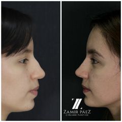 Rinoplastia - Dr. Zamir Páez