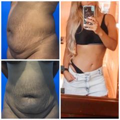 Abdominoplastia - Dr. Zamir Páez