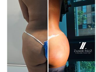 Gluteoplastia antes y después - 870410